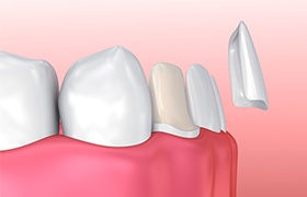 Animation of porcelain veneer placement