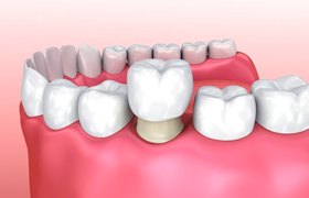 dental crown being placed over bottom molar