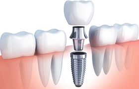 diagram of dental implants in New Bedford