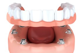 implant-retained dentures