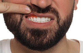 A close-up of inflamed gums showing early signs of gum disease