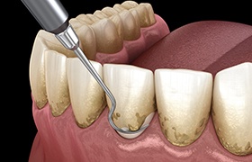 An illustration of scaling and root planing procedure for gum disease treatment