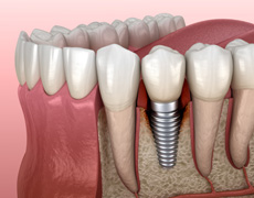 Illustration of a single dental implant