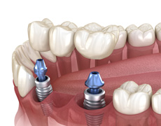 Illustration of an implant bridge