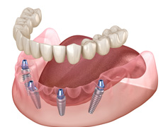 Illustration of an implant denture