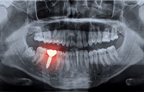 Highlighted X-ray of dental implant failure in New Bedford