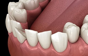 a 3 D digital illustration of crowded teeth