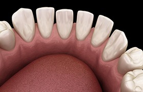 a 3 D illustration of gaps between teeth