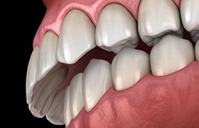 a 3 D example of an overbite