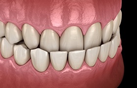 a 3 D example of an underbite 