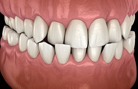 a 3 D illustration of a crossbite