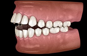 a 3 D illustration of an open bite