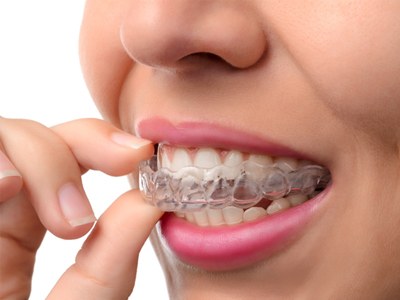Woman putting in a clear aligner tray 
