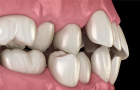 Digital image of crowded teeth 