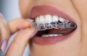 Patient placing clear aligner on top teeth