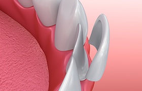 Digital image of porcelain veneer on a front tooth