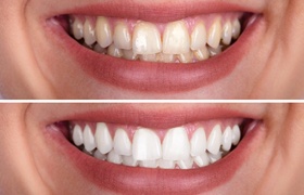 before and after teeth whitening