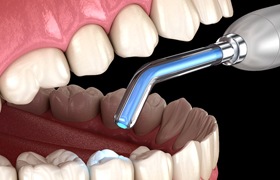 computer model of a tooth-colored filling being placed