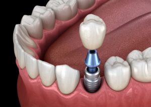 dental implant