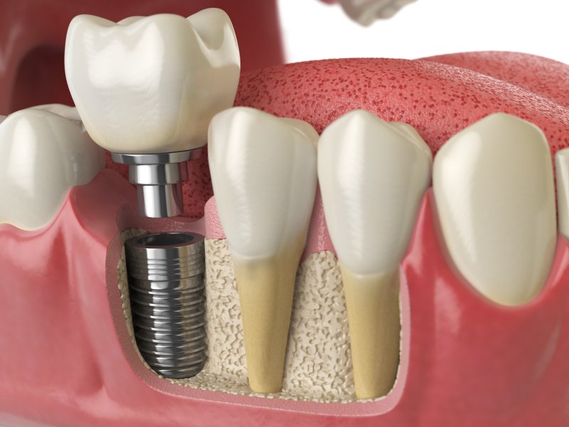 Illustration of dental implant