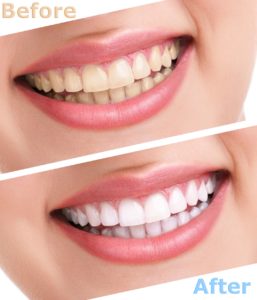 Teeth whitening results from cosmetic dentist in Bedford.