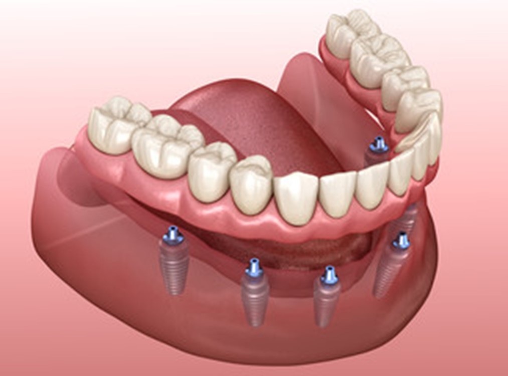 3-D diagram of dental implants