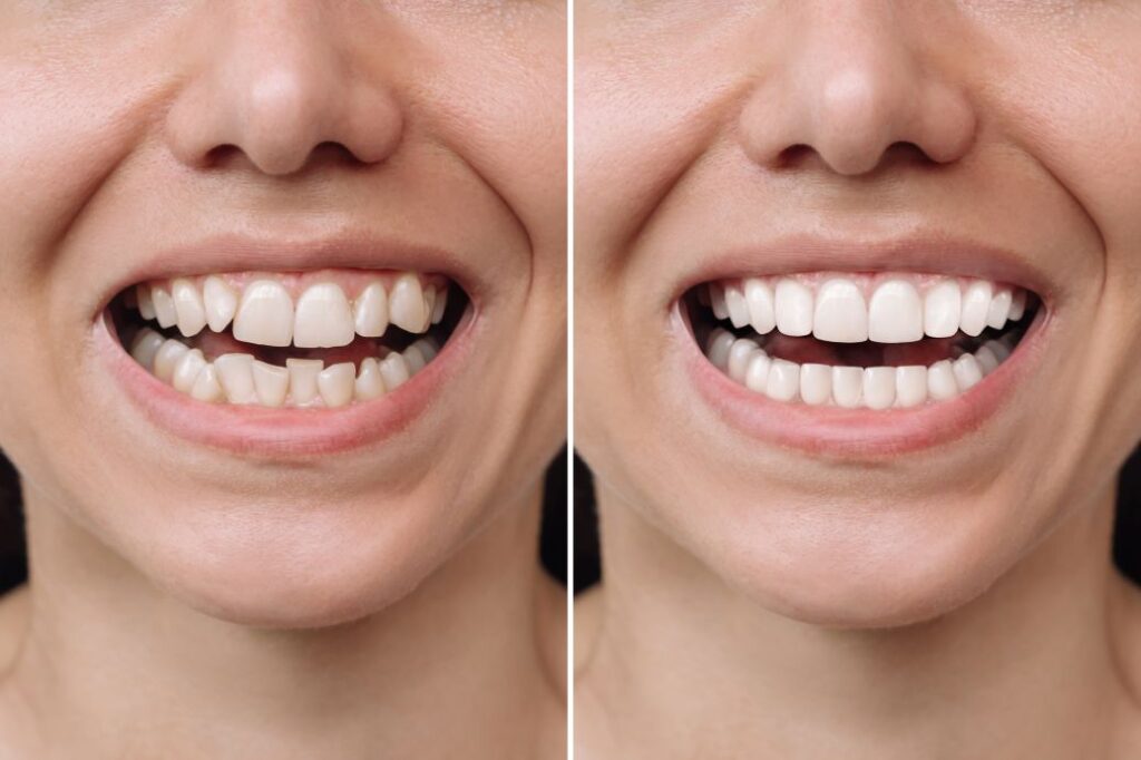 A woman’s smile before and after veneer treatment.