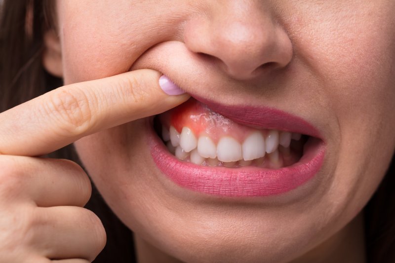 A woman revealing her sore and inflamed gums