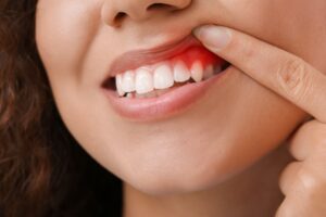 Woman with noticeably red gums